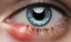 Home Remedies and Causes of Eye Styes Explained